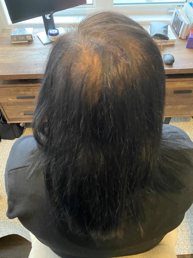 female with severe hair loss